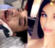 Amber Nicole bloody in a neck brace