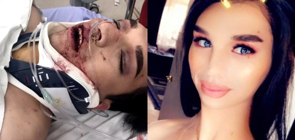 Amber Nicole bloody in a neck brace