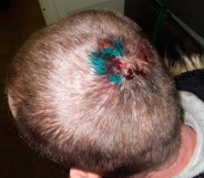 The injury sustained by a Russian man who claimed police beat him up because he's gay.
