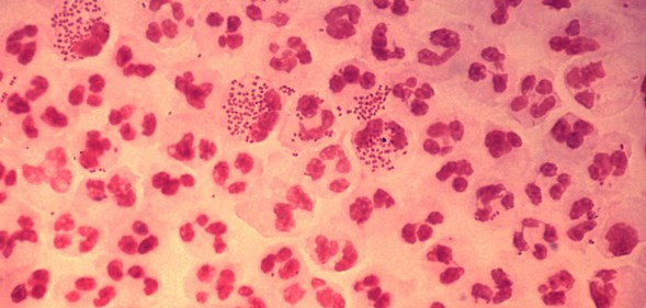 Gonorrhoea STI STD infection