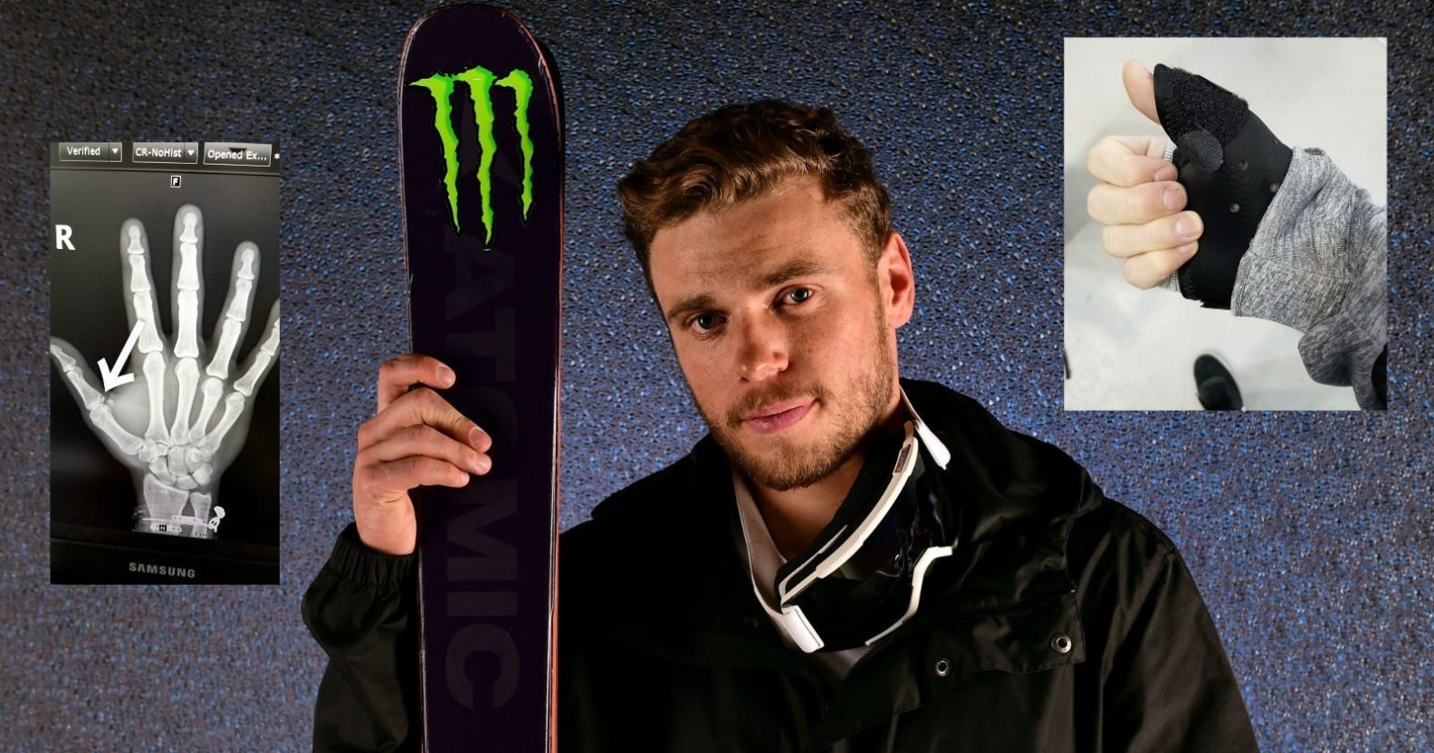 Gay Olympic skier Gus Kenworthy breaks his thumb, jokes about avoiding(02)