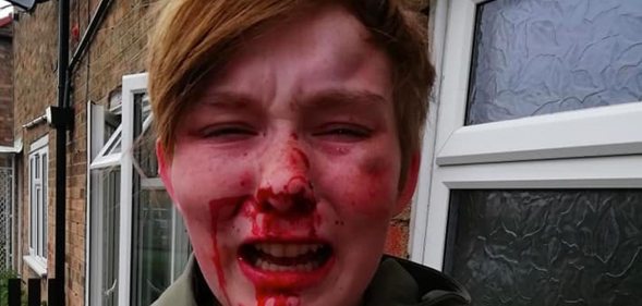 A woman with blood running down her nose