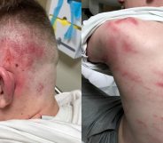 A teenager's head and torso with scratches and bruises