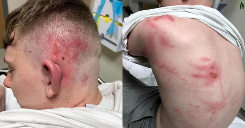 A teenager's head and torso with scratches and bruises