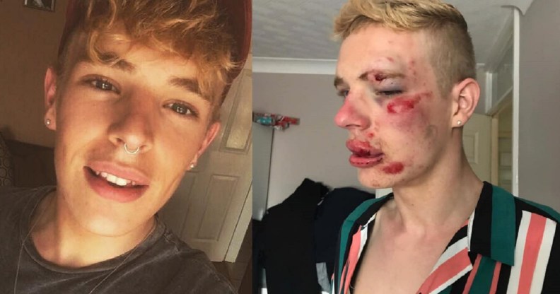 Ryan Turner was beaten up for being gay