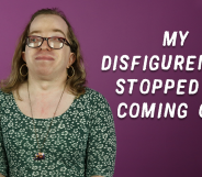 Disabled_disfigured_gay_transwoman
