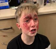 Charlie Graham, 20, was jumped by two homophobic individuals in Sunderland, England. (Michelle Storey/Facebook)