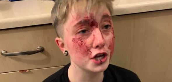 Charlie Graham, 20, was jumped by two homophobic individuals in Sunderland, England. (Michelle Storey/Facebook)