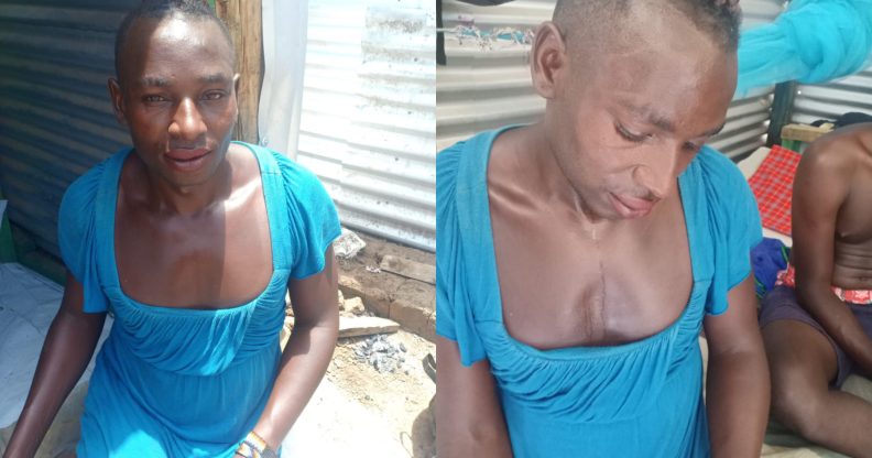 Stephen Sebuuma, a trans non-binary refugee in the Kakuma refugee camp, was battered by a group of 10 transphobes with sticks and stones. (Stephen Sebuuma)