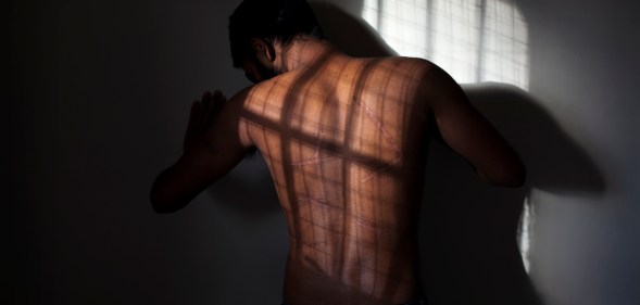 A man's back covered in scars