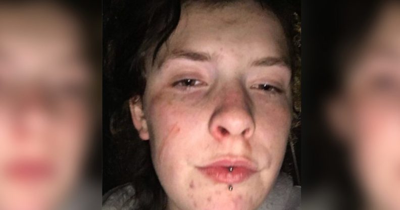 Queer 16-year-old viscously beaten by thugs in vile homophobic attack