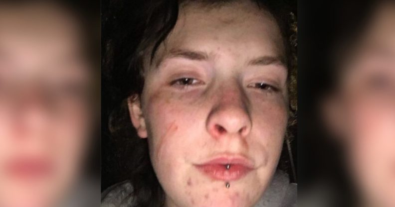 Queer 16-year-old viscously beaten by thugs in vile homophobic attack