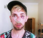 Poland: Gay man beaten up with 'telescopic baton' in broad daylight
