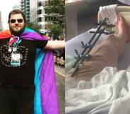 Justin Morissette wearing a rainbow flag as a cape / his leg with metalwork after surgery