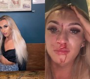 Anna Montgomery was beaten while she was enjoying drinks with her boyfriend in a bar. (Facebook)