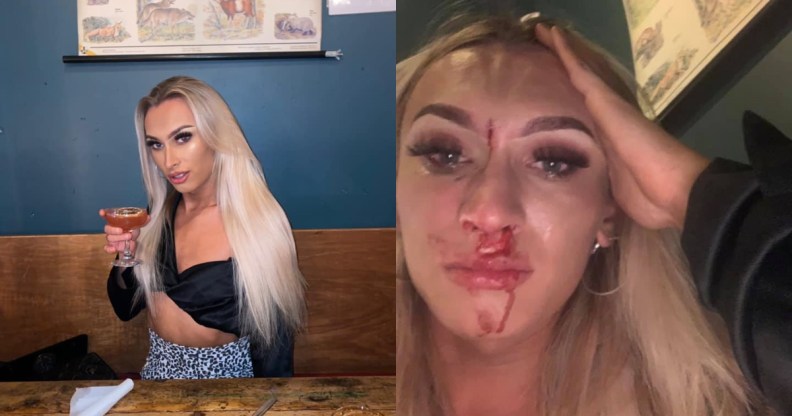 Anna Montgomery was beaten while she was enjoying drinks with her boyfriend in a bar. (Facebook)