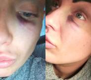 Mum beaten 'black and blue' with crowbar in homophobic pub attack
