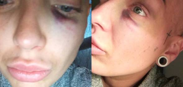Mum beaten 'black and blue' with crowbar in homophobic pub attack