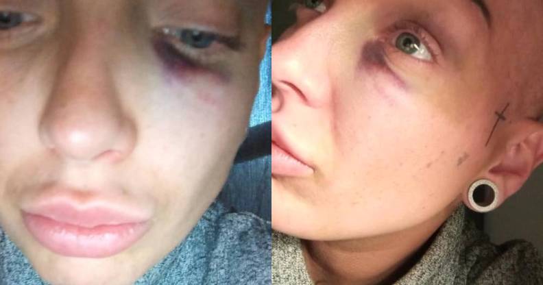 Mum beaten 'black and blue' with crowbar in homophobic pub attack