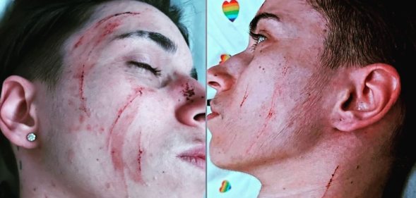 Side-by-side of Ruan Filipe with cuts on his face, cheeks and neck