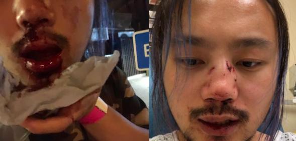 Side-by-side of Yang Wu, his mouth and nose bleeding