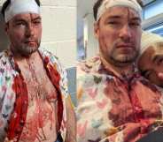 Rob and Patrick covered in blood following a homophobic hate crime in Birmingham