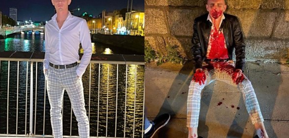 Irish Olympic athlete Jack Woolley before and after the attack