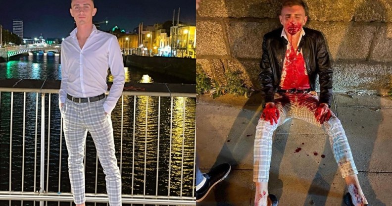 Irish Olympic athlete Jack Woolley before and after the attack