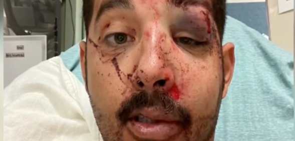 Gersson Saavedra in hospital with a bruised eye and stitches