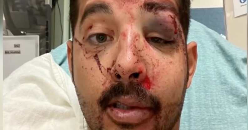 Gersson Saavedra in hospital with a bruised eye and stitches