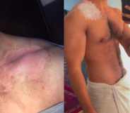 Sohil Afghanistan burn