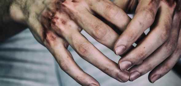 Bruised hands