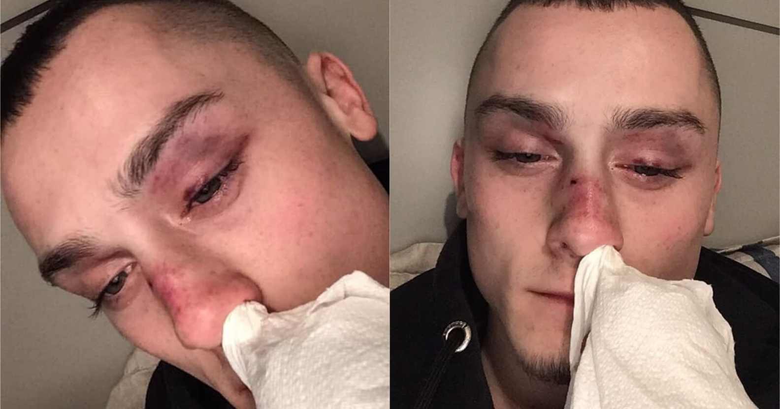 Ryan Winnard with bruises on his face after experiencing a homophobic assault
