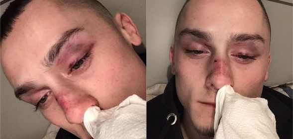 Ryan Winnard with bruises on his face after experiencing a homophobic assault