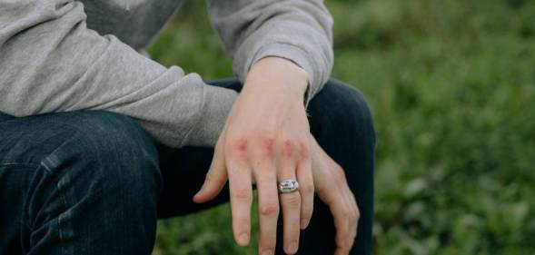 A person who is wearing a grey top and dark bottoms and a ring sits in a grassy area with bruised knuckles