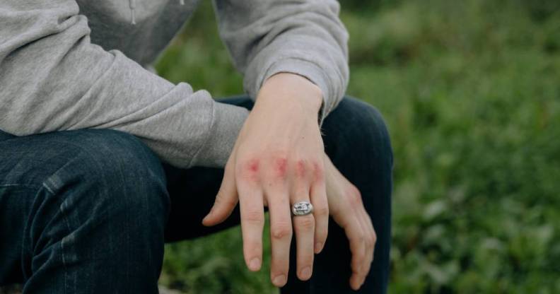 A person who is wearing a grey top and dark bottoms and a ring sits in a grassy area with bruised knuckles