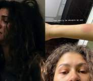 Zendaya ended up with bruises while filming Euphoria