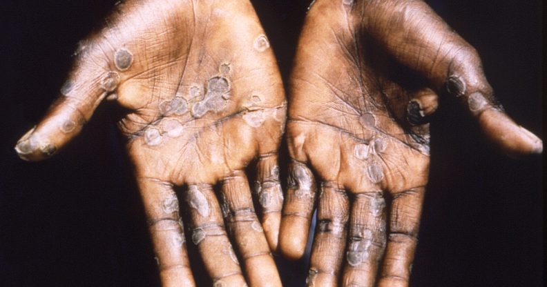 New isolation advice has been recommended for high-risk contacts of those with monkeypox