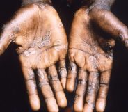 New isolation advice has been recommended for high-risk contacts of those with monkeypox