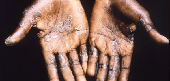New isolation advice has been recommended for high-risk contacts of those with monkeypox