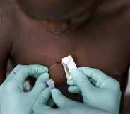 A teenager with suspected monkeypox