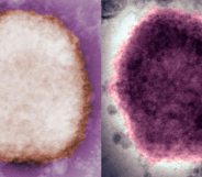 The monkeypox virus under a microscope.