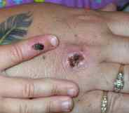 Monkeypox scabs.