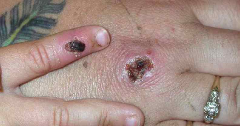 Monkeypox scabs.