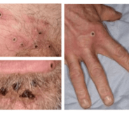 Monkeypox lesions