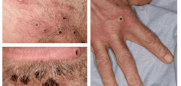 Monkeypox lesions