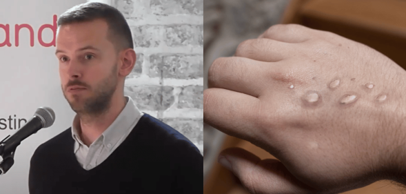 Gay man recalls 'total nightmare' of contracting 'agonising' monkeypox at Pride