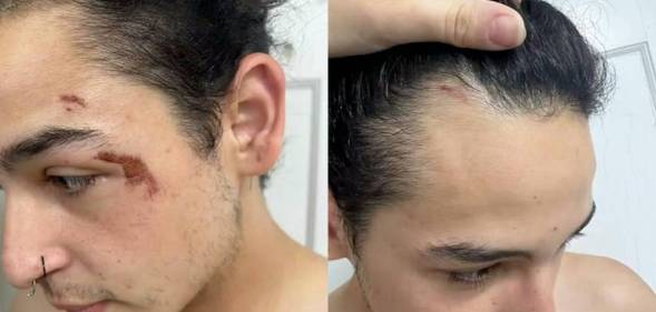 Side by side pictures of a trans man highlighting a cut near his eye and near his hairline after he was attacked at a campground in Ohio because he used the women's restrooms as instructed by the owner