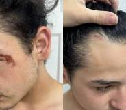 Side by side pictures of a trans man highlighting a cut near his eye and near his hairline after he was attacked at a campground in Ohio because he used the women's restrooms as instructed by the owner