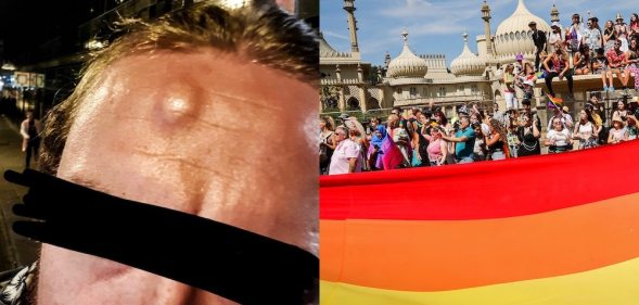 The customer's injuries side-by-side with a photograph of Pride goers in Brighton